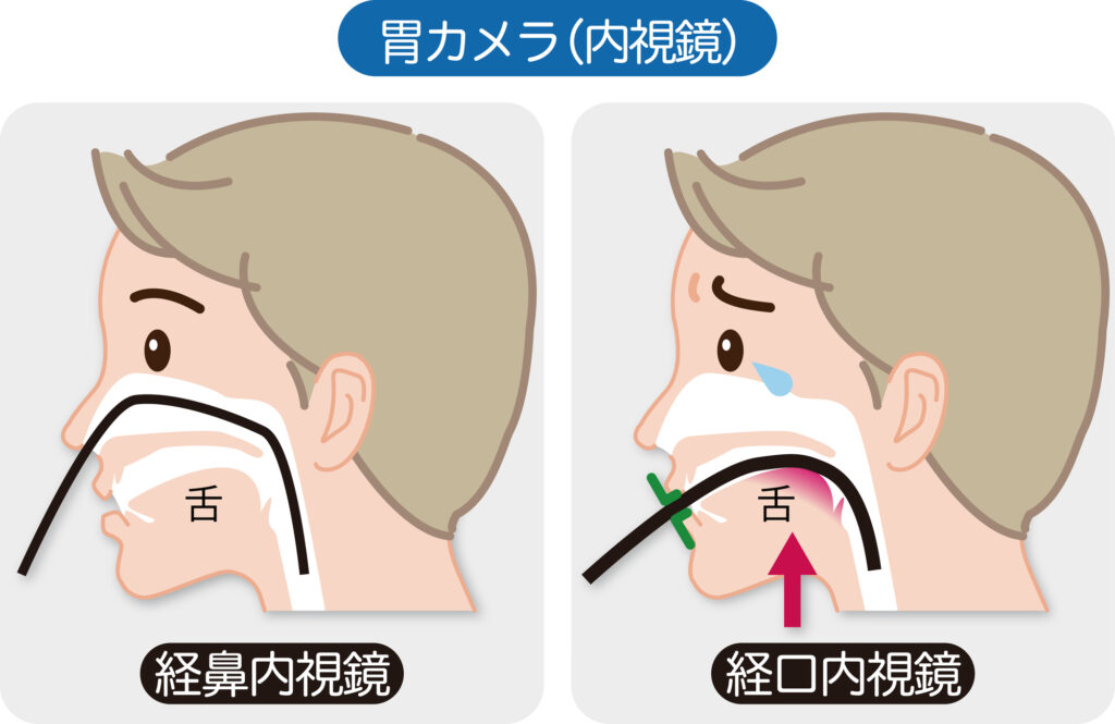 経鼻・経口胃内視鏡検査