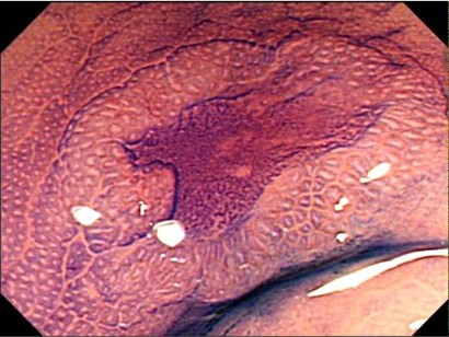 陥凹型大腸がん