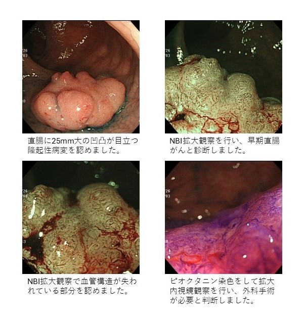 早期直腸がん（粘膜下層深部浸潤癌）