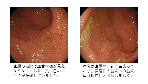 潰瘍性大腸炎　軽症