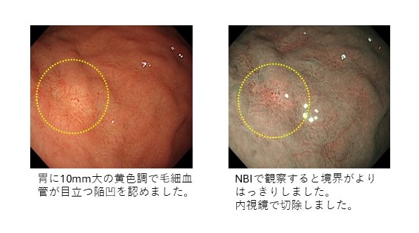 3. 早期胃がん（胃底腺型腺癌）