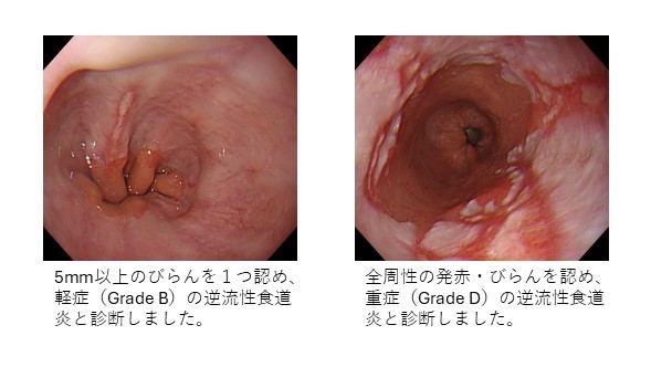 逆流性食道炎