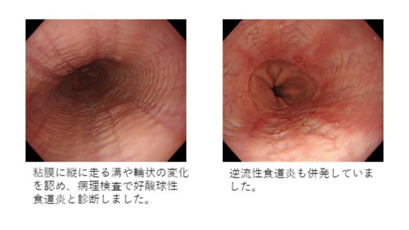 好酸球性食道炎