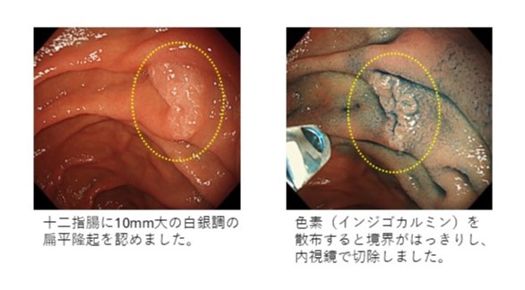 十二指腸腺腫