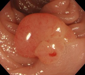 拡大内視鏡観察→早期癌と診断