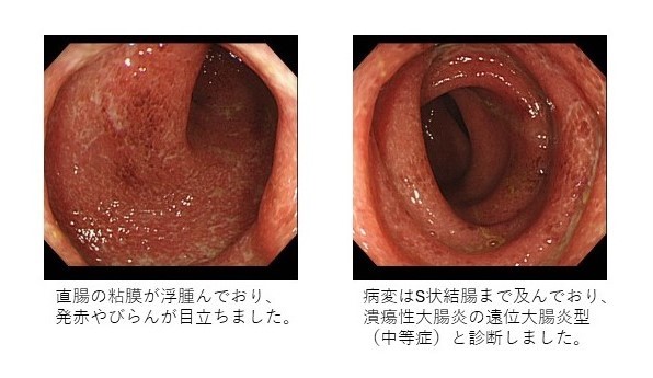 潰瘍性大腸炎　中等症