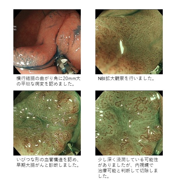 早期大腸がん（粘膜内癌）