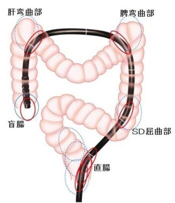 軸保持短縮法