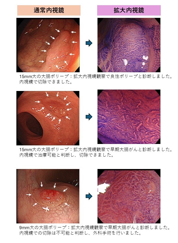 拡大内視鏡観察