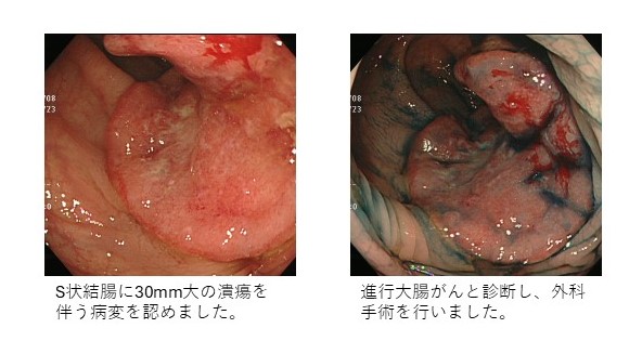 進行大腸がん