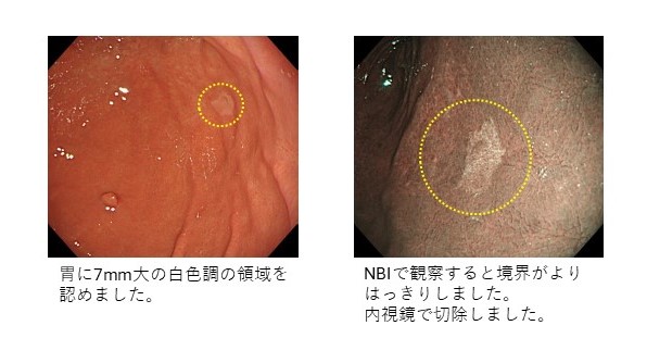 2. 早期胃がん（印環細胞癌）