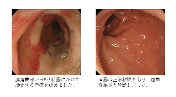 虚血性腸炎