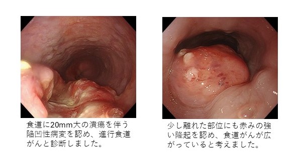 進行食道がん