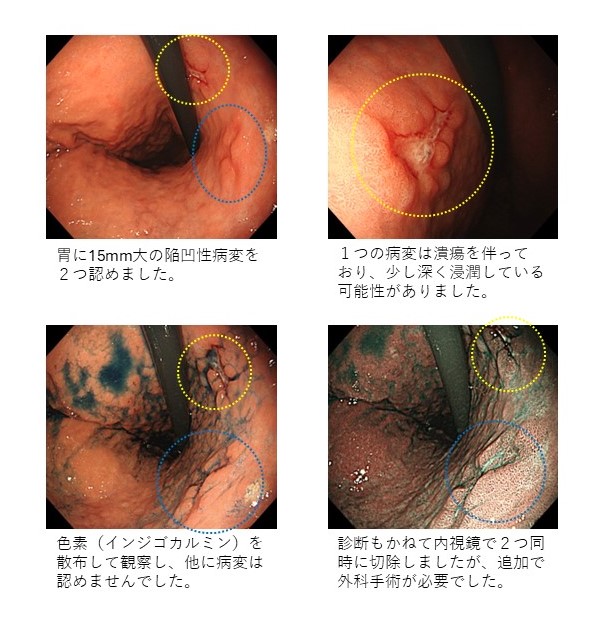 同時多発早期胃がん（高分化腺癌）