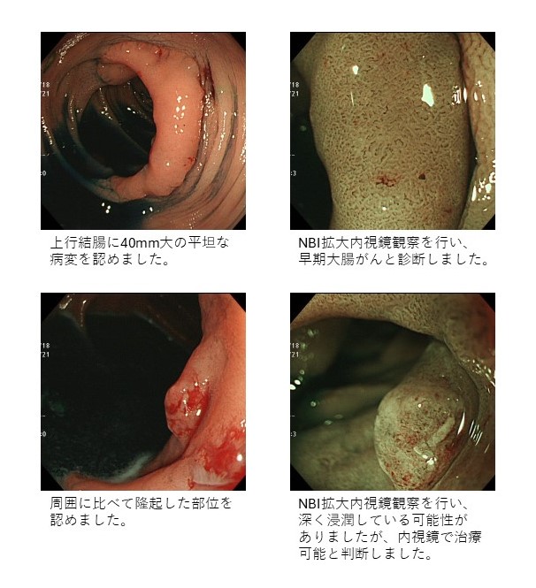 早期大腸がん（粘膜下層軽度浸潤癌）