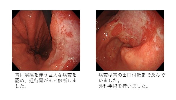6. 進行胃がん
