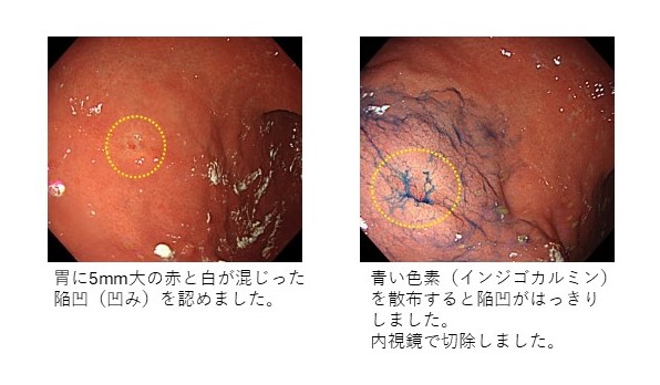 1. 早期胃がん（印環細胞癌）